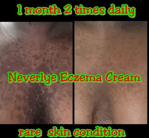 PRE-NEVERLYE ECZEMA &PSORIASIS CREAM FREE OATMEAL SOAP