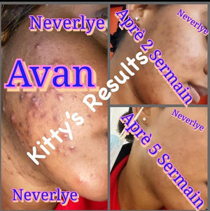 NEVERLYE ACNE SERUM