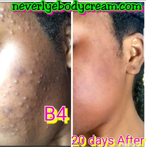 NEVERLYE ACNE SERUM