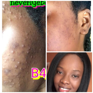 3-NEVERLYE BLACK ACNE SOAP